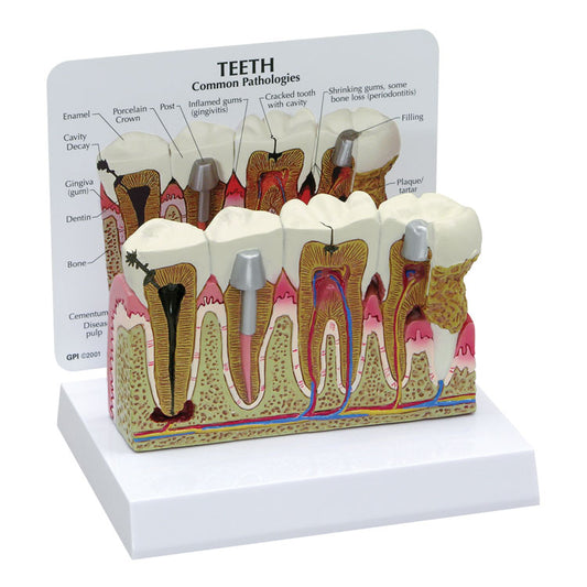 Teeth Model - Common Pathologies