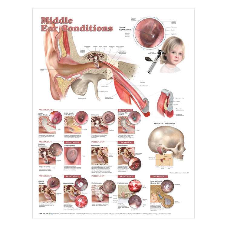 Middle Ear Conditions